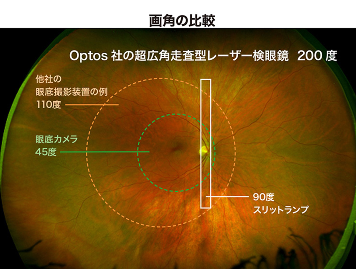 写真：画像の比較　Optos社の超広角走査型レーザー検眼鏡200度　他社の眼底撮影装置の例110度　眼底カメラ45度　90度スリットランプ
